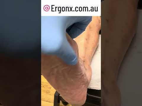 Forefoot callus removal in podiatry clinic by Ergonx