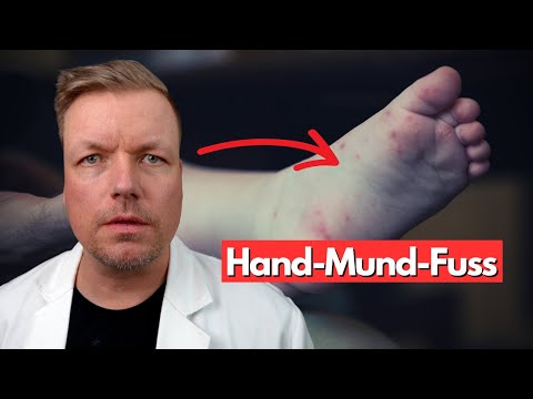 Video: Hand-Fuß-Mund-Krankheit erkennen und behandeln - Gunook