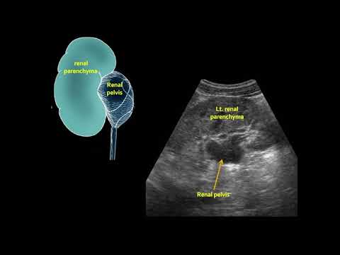 Video: Apakah itu pelvis ekstrarenal?