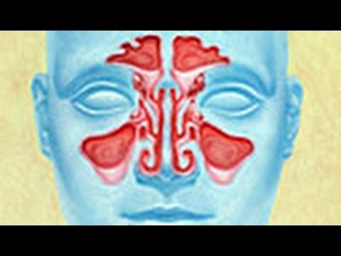 Nasal Irrigation