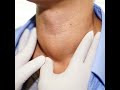 Thyroid Emergencies