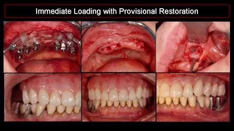 Prof. Peter Moy: Determining successful loading protocols. At the Osstell Scientific Symposium 200