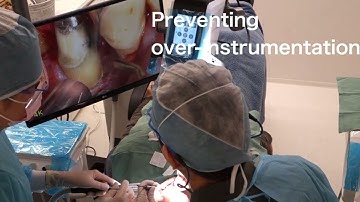 Prevent Over instrumentation with the Mielscope