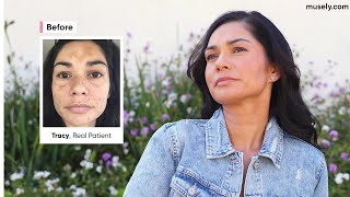 MUSELY's THE SPOT CREAM | "I feel beautiful" | REAL PATIENT REVIEW OF MUSELY SKINCARE