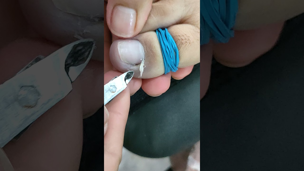 Impacted or ingrown toenail pedicure