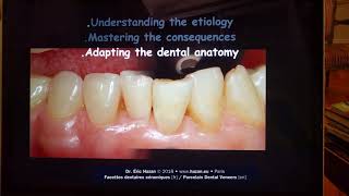 Porcelain Laminate Veneers to restore the mandibular incisal sector