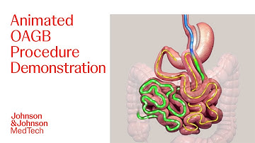 One Anastomosis Gastric Bypass (OAGB) Animated Patient Education Video | J&J MedTech