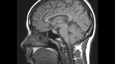 Why Lie-Detection Brain Scan is Not Used in Court