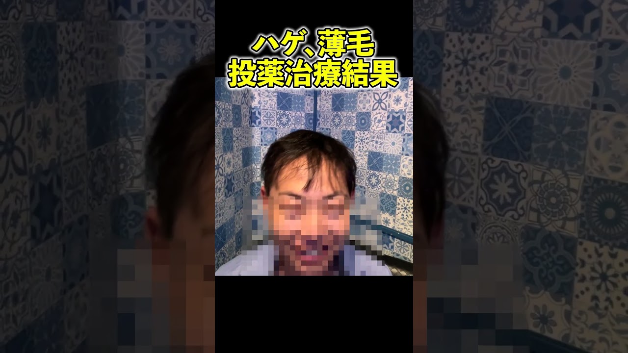 2年間のAGA投薬治療の結果… #shorts