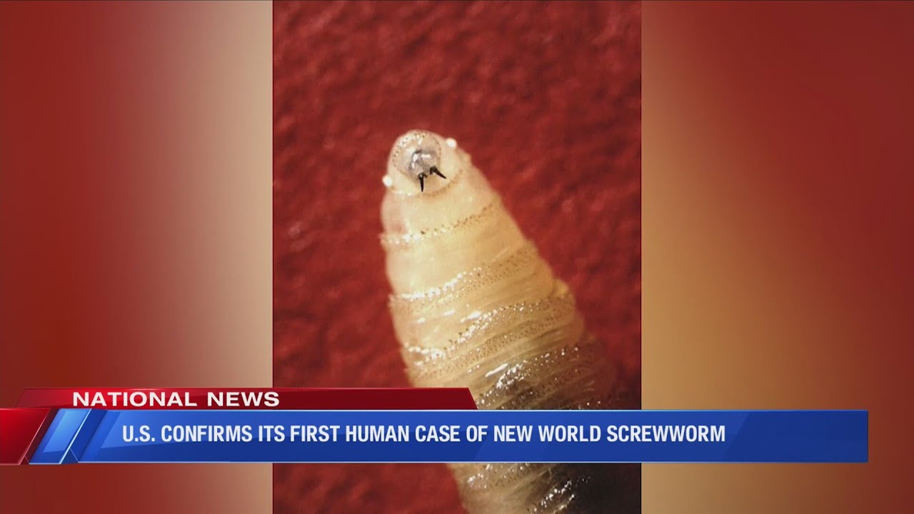 U.S. confirms its first human case of new world screwworm