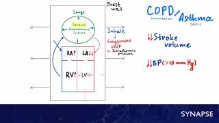 USMLE Step 1 - Pulsus Paradoxus Resimi