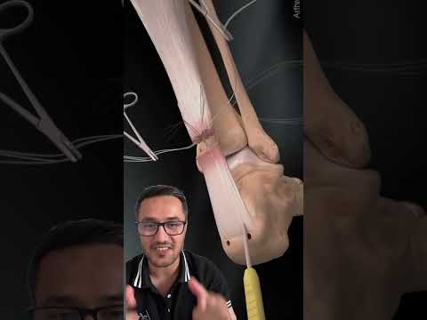 Aşil tendonu ameliyatı nasıl yapılır