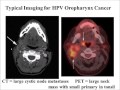 HPV and Oropharynx Cancer