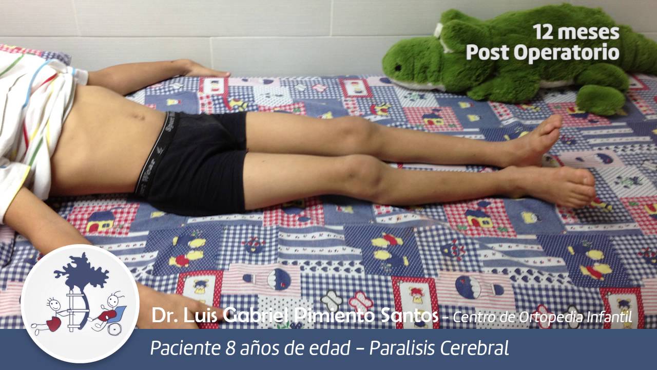 Paralisis Cerebral Infantil (Diplejía Espástica)