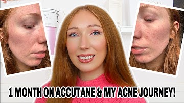 1ST MONTH ON ROACCUTANE & MY ACNE JOURNEY | Side Effects, Updates, Natural Photos & Videos