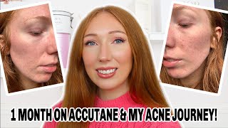 1ST MONTH ON ROACCUTANE &amp; MY ACNE JOURNEY | Side Effects, Updates, Natural Photos &amp; Videos