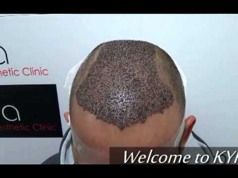 Hair Transplant in Ludhiana Punjab  Cost Clinic  FCHTC