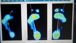 Do I Need Orthotics?