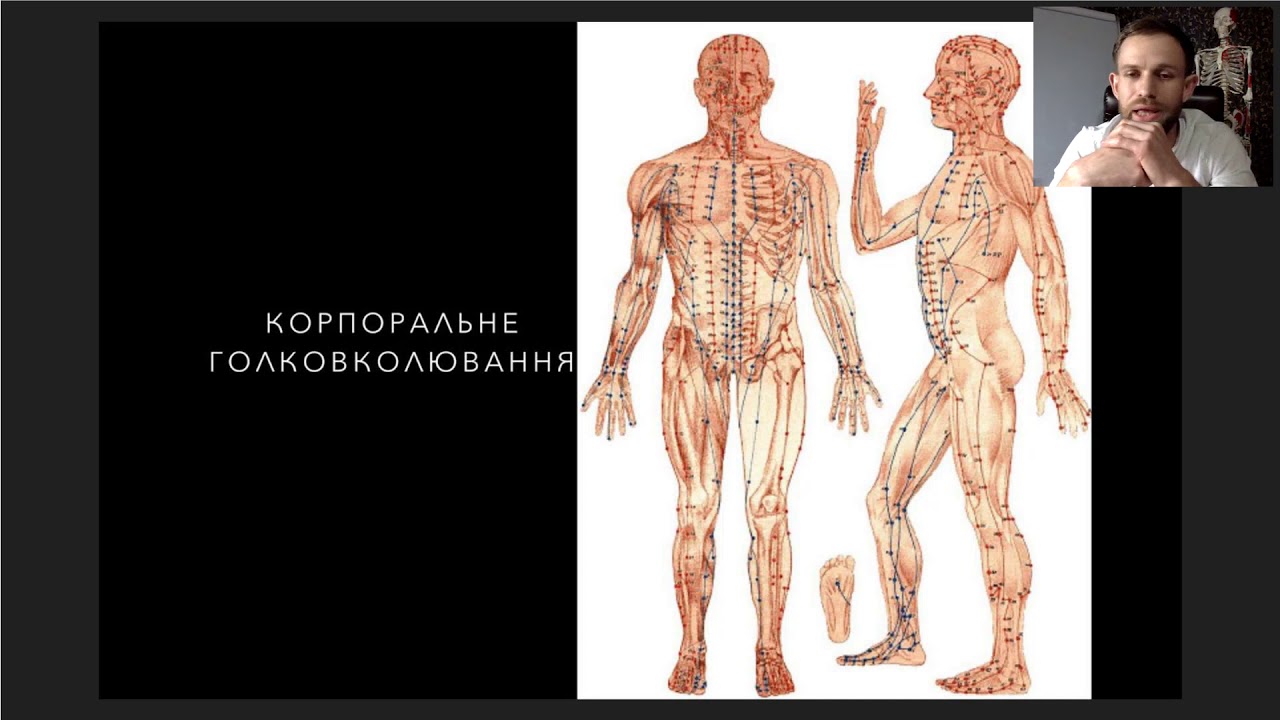 Dry needle или метод сухой иглы. - YouTube