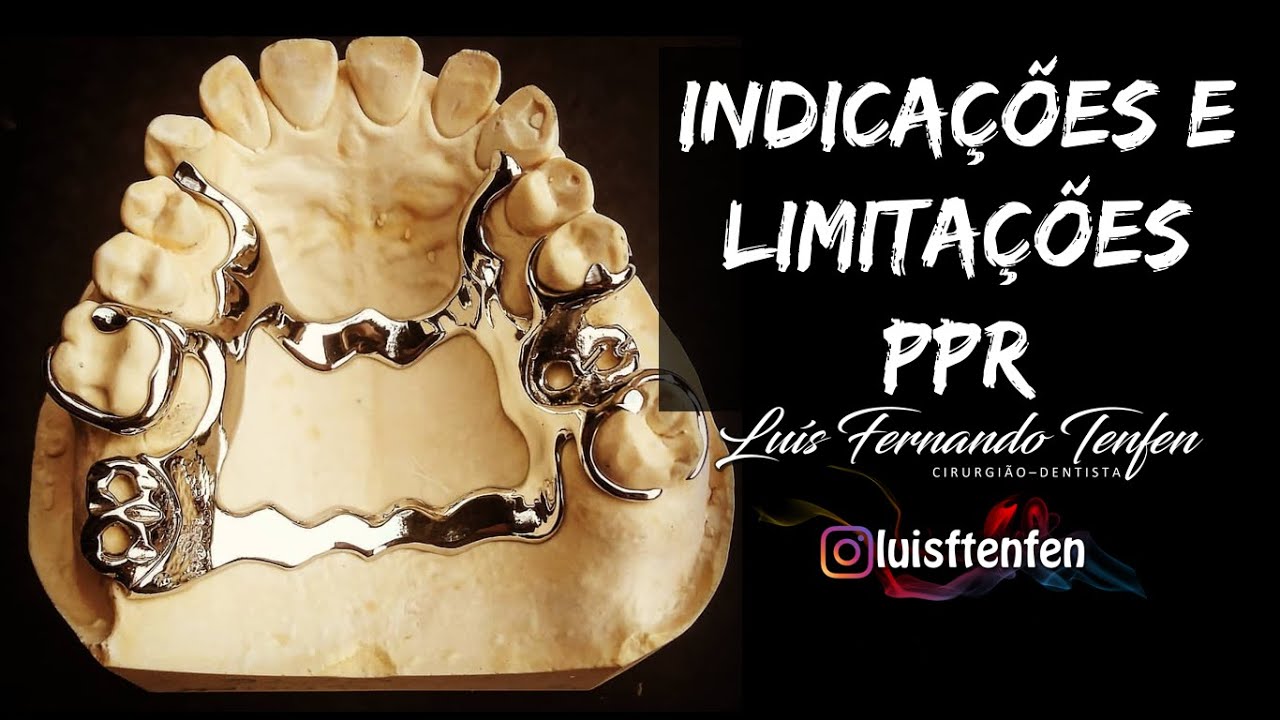 Prótese Parcial Removível #1: Indicações e Limitações