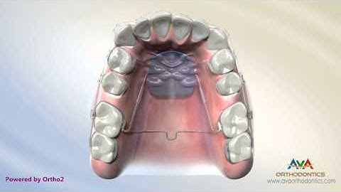 Orthodontic Space Management - Distal Jet Appliance