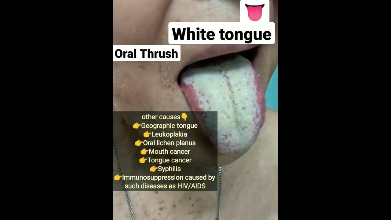 Oral Thrush- Antibiotics side effects #neet #next #mbbs - YouTube