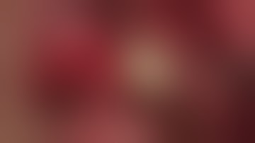 Gingival Augmentation during Implants exposure - Mucoderm (Botiss) by Dr Bernard Dahan