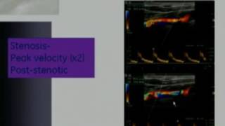 Carotid Doppler Protocol and Top Tips