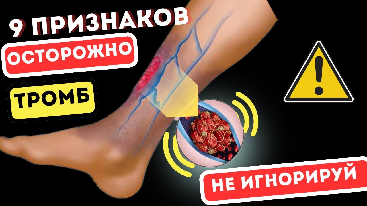 9 Признаков того, что появился ТРОМБ! Тело предупреждает, НЕ Пропусти ...
