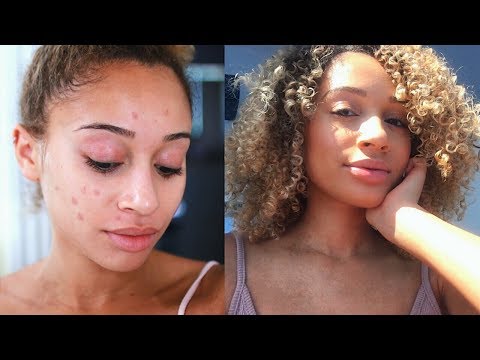  Easy Ways To Get Rid of Acne/Dark Marks! All Skin Types