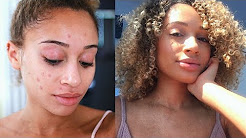 10 Easy Ways To Get Rid of Acne/Dark Marks! All Skin Types