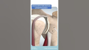 Laterjet: ❓Have you ever had a patient with this surgery? 💪🏻Was anything different with their rehab?