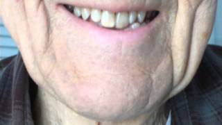 39 years and counting! Flat plane splint wear