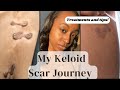 My Keloid Scar Journey! | What treatments have I done?| Surgery, Injections, Radiation??
