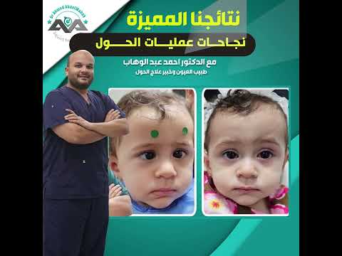 نتائجنا المميزة لعلاج الحول مع الدكتور أحمد عبدالوهاب