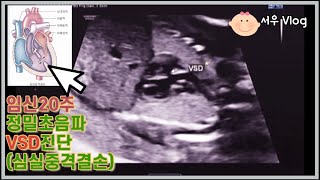 임신20주/정밀초음파/05:25/태아심장구멍/기형아검사고위험/니프티정상/VSD/