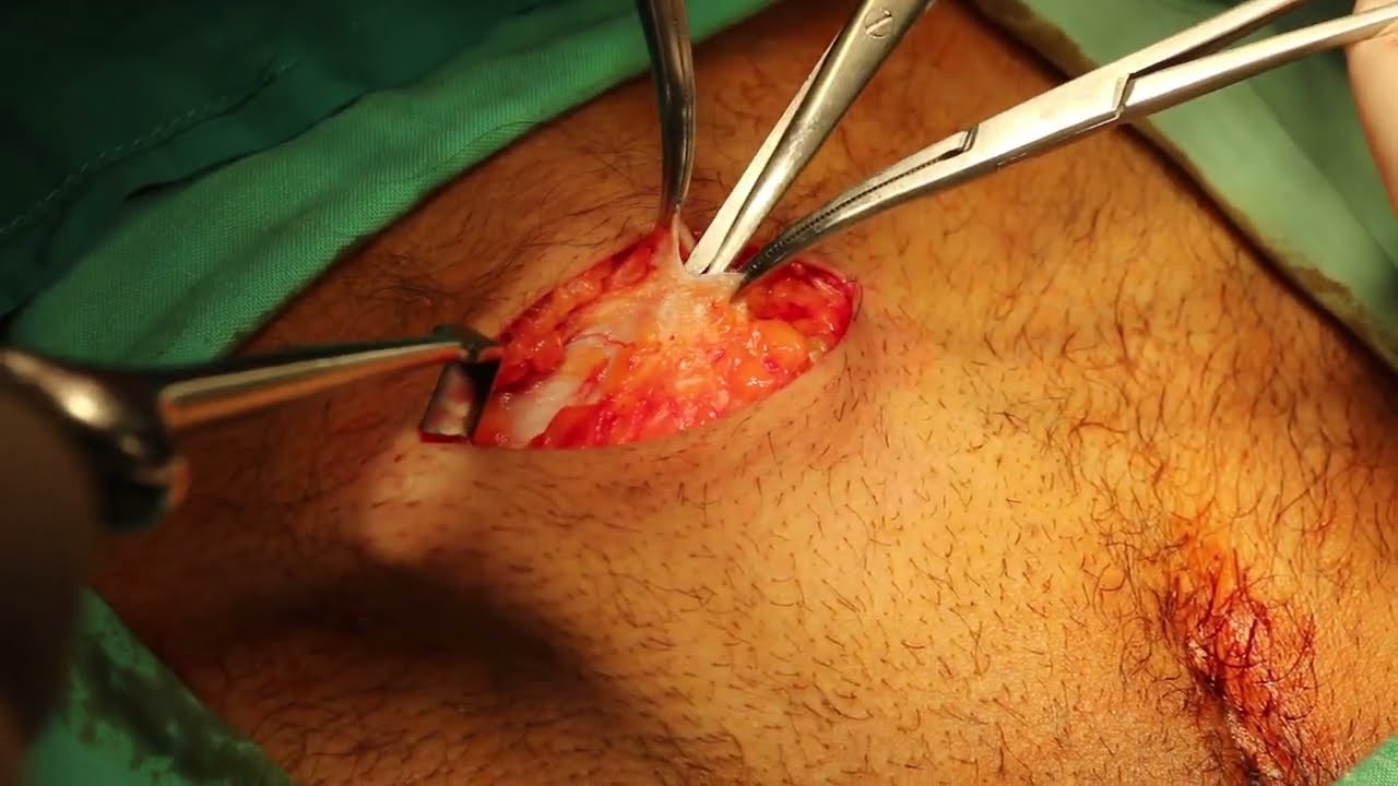 Pfannenstiel incision, Classic Opening and Closure