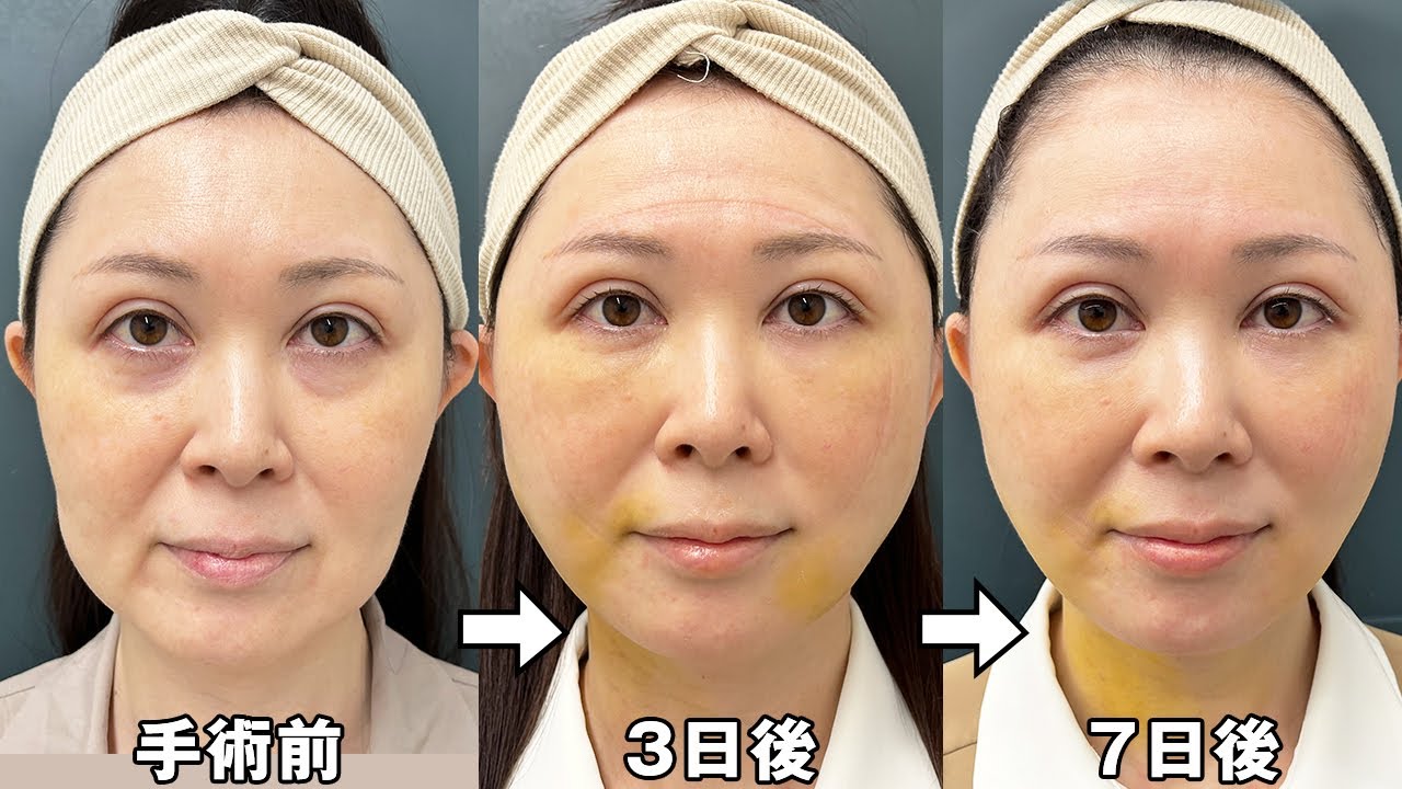48歳 フェイスリフト】ダウンタイム傷跡の経過に密着 - YouTube