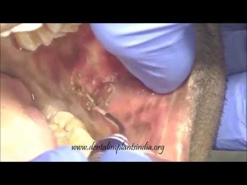 Leukoplakia of Buccal mucosa removal by laser