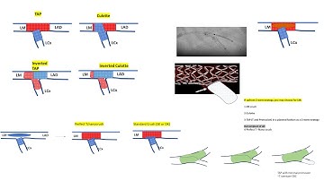 Bifurcation left main stenting- Elias Hanna