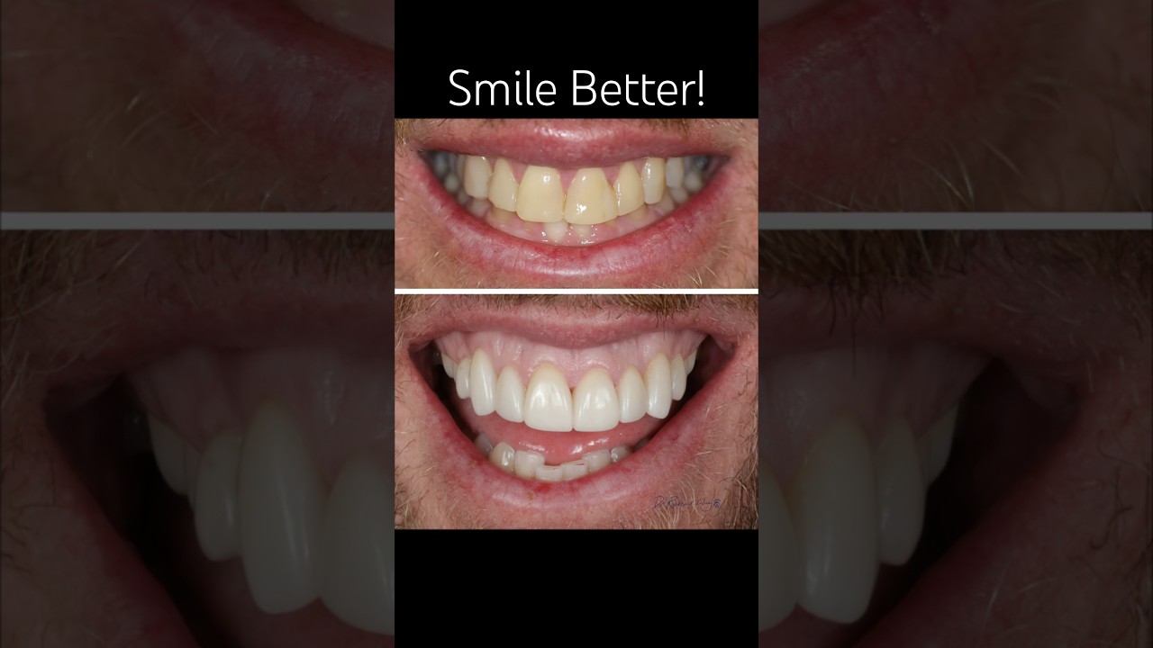 How to Whiten Teeth, 6,990 for 8 x Teeth, porcelain glass ceramic