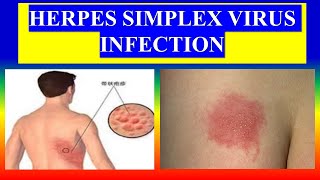 HERPES SIMPLEX VIRUS INFECTION- Define ,etiology ,types ,incidence ,risk,pathophysiology,management