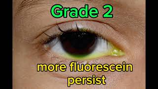Fluorescein Dye Disappearance Test (FDDT) grading
