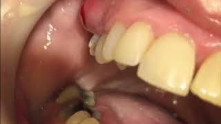 Draining Dental Abcess in the Mouth