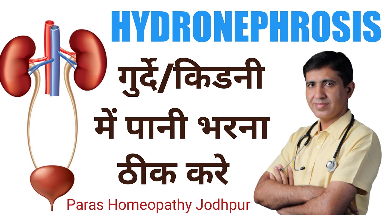All About Hydronephrosis Homeopathy Treatment | किड्नी में पानी भर जाना | Best Homeopathic Medicine