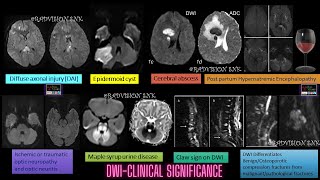 DIFFUSION WEIGHTED IMAGING (DWI) -CLINICAL SIGNIFICANCE