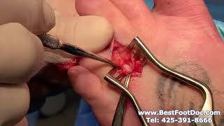 Dr. Timothy Young Performs a Morton&#39;s Neuroma Surgery - Part 1