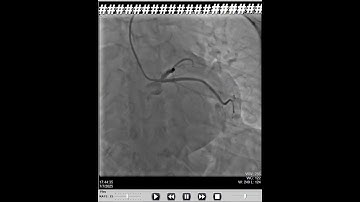 Thumbnail of NORMAL ANGIO #shorts #angiography #youtubeshorts
