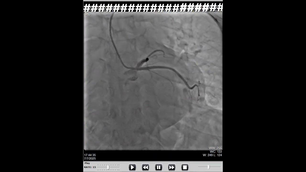 NORMAL ANGIO #shorts #angiography #youtubeshorts