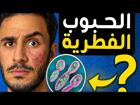 الحبوب الفطرية الأسباب الفرق عن حب الشباب وأسرع طرق العلاج